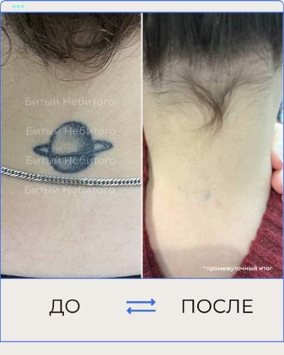 Удаление татуировки